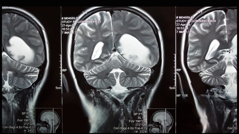 MRI of a brain with a tumor. A friendship was over after a friend wouldn't help.